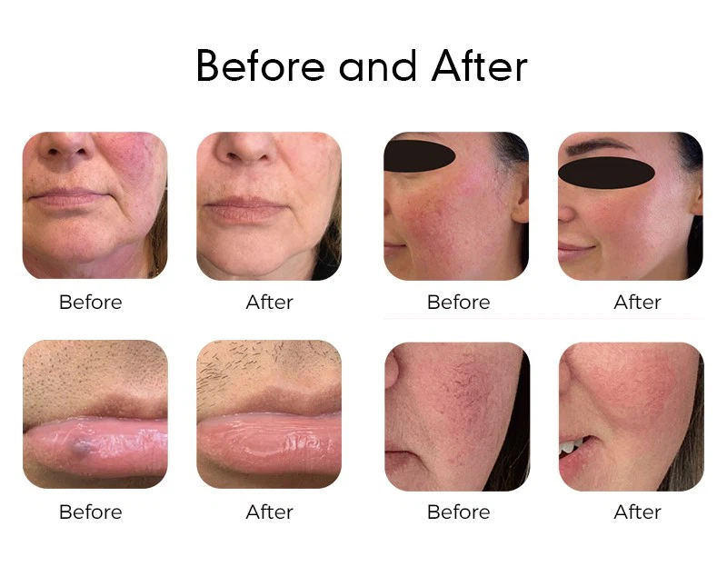 980nm Diode Laser For Vascular Removal 980nm Diode Laser For Vascular Removal